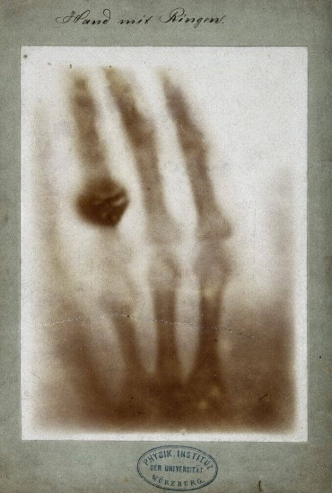 صورة مأخوذة بالأشعة السينية لليد اليسرى لزوجة العالم فيلهلم رونتجن ويظهر في الصورة خاتم الزواج