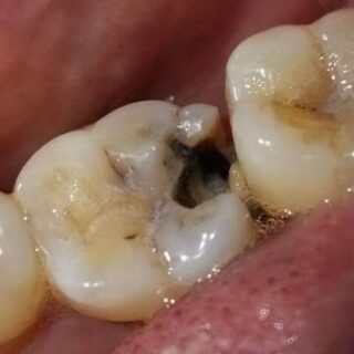 سن به تسوس أسود داخل الفم