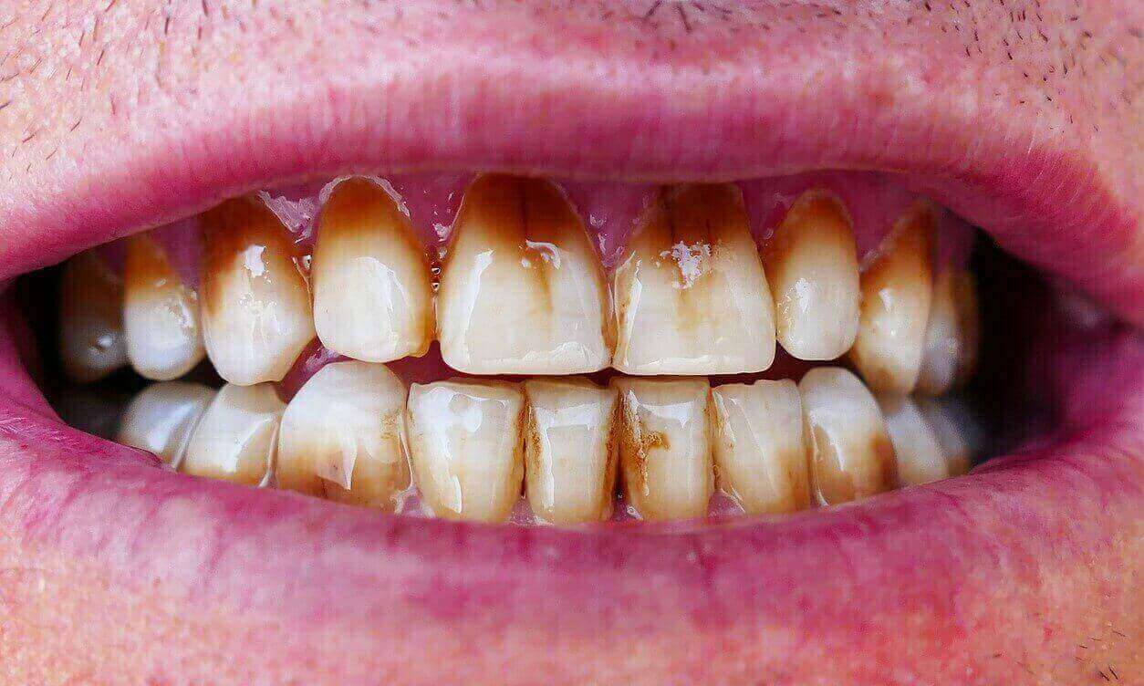 اسنان بشرية لونها ابيض مصفر يظهر عليها بقع ملطخة باللون البني دلالة على مشكلة في بنية السن