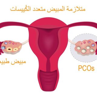 رسم توضيحي لرحم أنثى الإنسان ويظهر مبيض طبيعي ومبيض مصاب بمتلازمة المبيض المتعدد الكييسات
