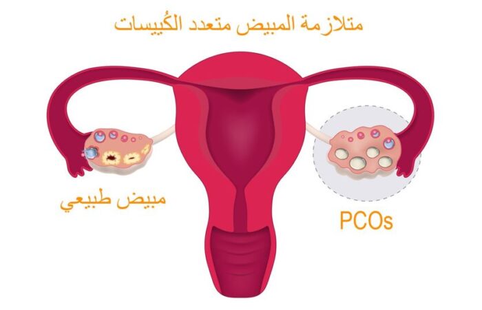 رسم توضيحي لرحم أنثى الإنسان ويظهر مبيض طبيعي ومبيض مصاب بمتلازمة المبيض المتعدد الكييسات