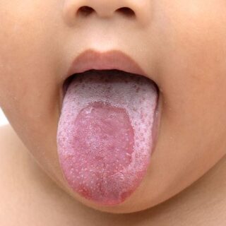 صبي يمد لسانه للخارج ويظهر لسانه باللون الأبيض وفي منتصف اللسان توجد بقعة حمراء دلالة على الإصابة باللسان الجغرافي