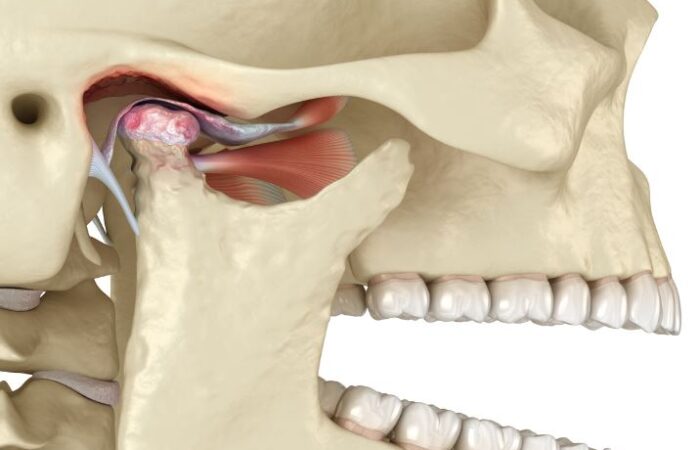 رسم تشريحي لعظام الفك عند الإنسان ويظهر المفصل الفكي الصدغي والأربطة العضلية المجاورة له