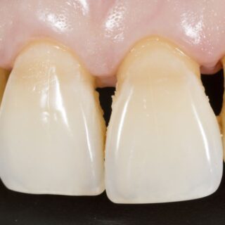 أسنان علوية تظهر فراغات بينها كما يظهر عدم معانقة اللثة لها بشكل كامل بسبب الإصابة بالانحسار اللثوي