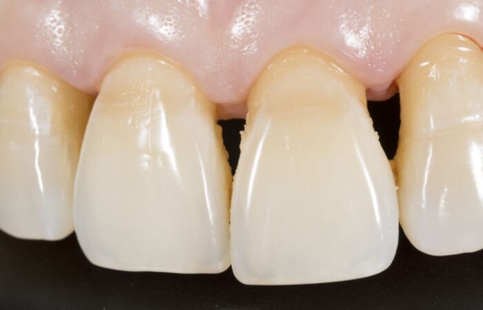 أسنان علوية تظهر فراغات بينها كما يظهر عدم معانقة اللثة لها بشكل كامل بسبب الإصابة بالانحسار اللثوي