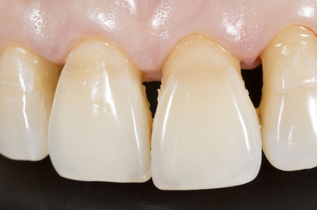 أسنان علوية تظهر فراغات بينها كما يظهر عدم معانقة اللثة لها بشكل كامل بسبب الإصابة بالانحسار اللثوي
