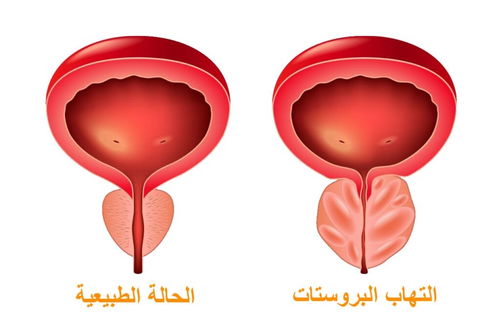 رسم توضيحي يوضح الفرق بين حجم البروستات الطبيعية والحجم عند الإصابة بالتهاب البروستات