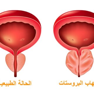 رسم توضيحي يوضح الفرق بين حجم البروستات الطبيعية والحجم عند الإصابة بالتهاب البروستات