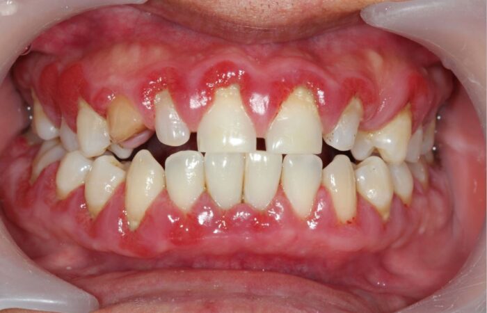 الأسنان العلوية والسفلية لشخص بالغ وتظهر اللثة متضخمة تحت الأسنان وذلك بسبب الإصابة بالضخامة اللثوية