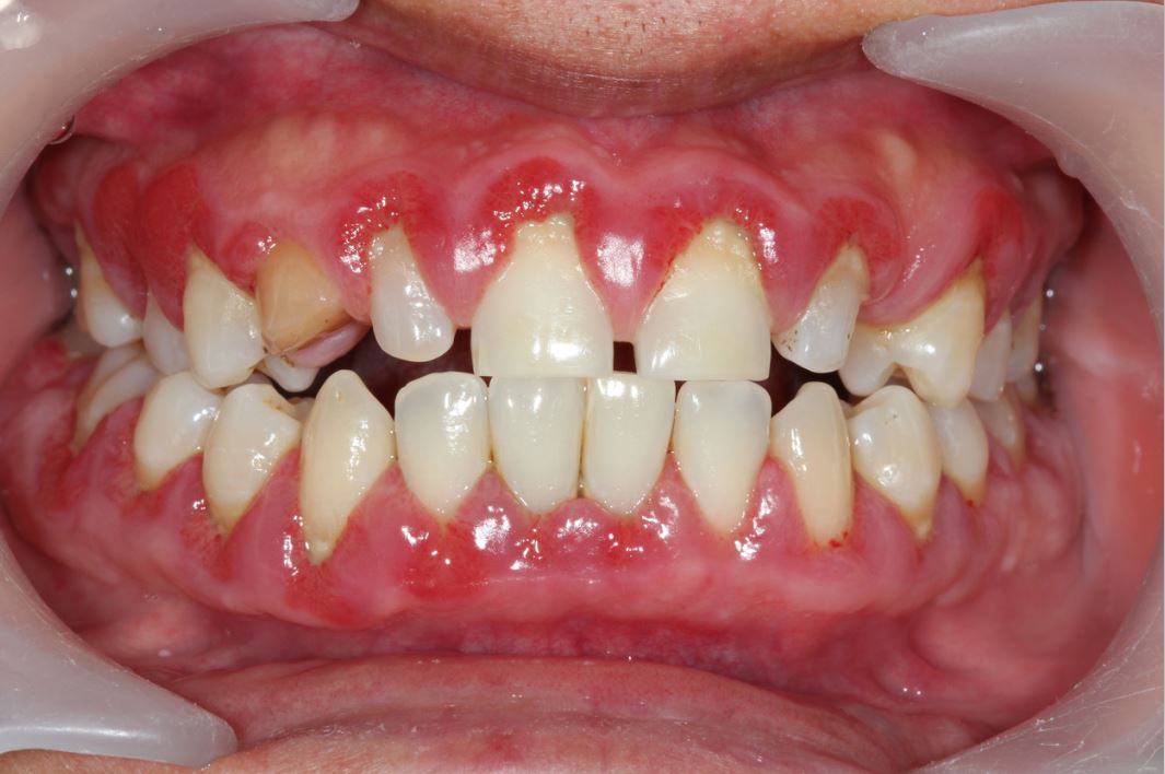 الأسنان العلوية والسفلية لشخص بالغ وتظهر اللثة متضخمة تحت الأسنان وذلك بسبب الإصابة بالضخامة اللثوية