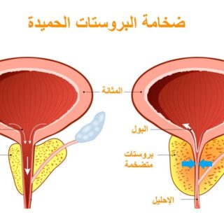رسم توضيحي يبين الفرق بين البروستات الطبيعية والبروستات المتضخمة عند الرجل