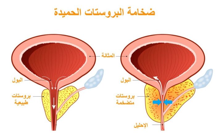 رسم توضيحي يبين الفرق بين البروستات الطبيعية والبروستات المتضخمة عند الرجل