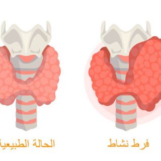 رسم توضيحي للغدة الدرقية في حالتها الطبيعية و في حالة تضخم بسبب فرط نشاطها