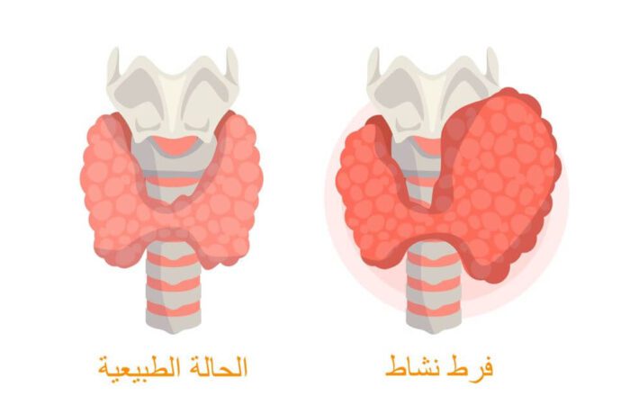 رسم توضيحي للغدة الدرقية في حالتها الطبيعية و في حالة تضخم بسبب فرط نشاطها