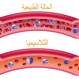 رسمة توضيحية لمرض الثلاسيميا من خلال عرض مقطع طولي لشرياني دم أحدهما بالحالة الطبيعية والتي يحتوي على العديد من كريات الدم الحمراء والآخر في حالة الثلاسيميا وفيه كريات دم قليلة