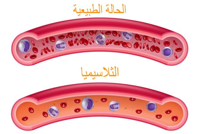 رسمة توضيحية لمرض الثلاسيميا من خلال عرض مقطع طولي لشرياني دم أحدهما بالحالة الطبيعية والتي يحتوي على العديد من كريات الدم الحمراء والآخر في حالة الثلاسيميا وفيه كريات دم قليلة