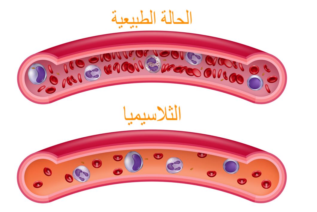 رسمة توضيحية لمرض الثلاسيميا من خلال عرض مقطع طولي لشرياني دم أحدهما بالحالة الطبيعية والتي يحتوي على العديد من كريات الدم الحمراء والآخر في حالة الثلاسيميا وفيه كريات دم قليلة