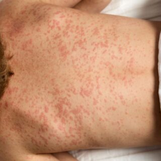 صبي يستلقي على ظهره في المستشفى ويكشف عن ظهره الممتلئ ببقع حمراء نتيجة تعرضه للحساسية الدوائية