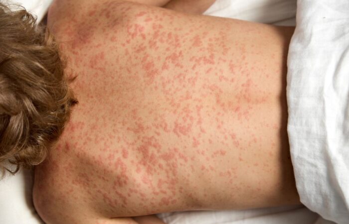 صبي يستلقي على ظهره في المستشفى ويكشف عن ظهره الممتلئ ببقع حمراء نتيجة تعرضه للحساسية الدوائية