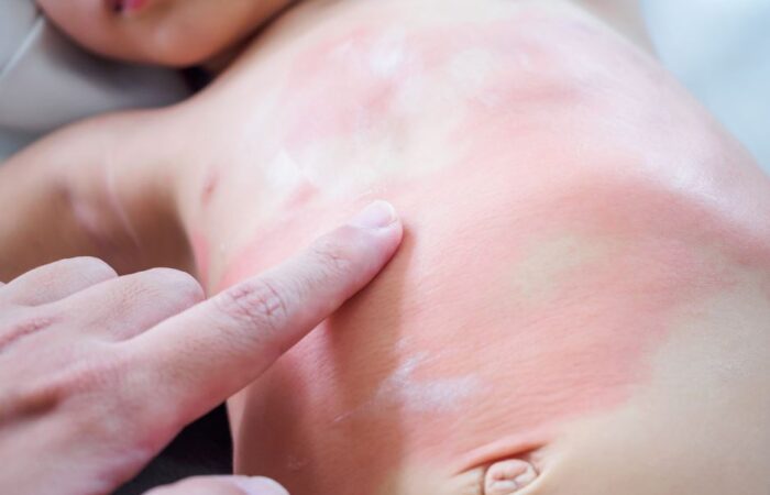 طفل رضيع مستلقي على ظهره وتظهر بقع حمراء كبيرة على بطنه بسبب تعرضه لحساسية الطعام وتقوم والدته بوضع اصبع يدها على بطنه