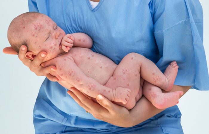 ممرضة تلبس ثياب طبية زرقاء وتحمل بين يديها طفل رضيع عاري ويظهر على كامل جسمه بقع جلدية حمراء بسبب اصابته بالحصبة