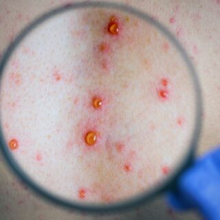 أكياس جلدية صغيرة حمراء اللون بداخلها تجمع للمياه والالتهابات