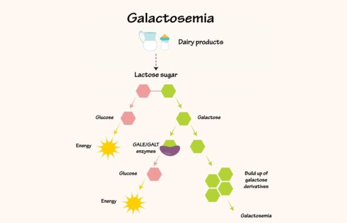 رسم توضيحي لتفاعل الغالاكتوزيميا