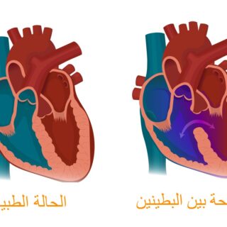 رسم تشريحي للقلب في الحالة الطبيعية وفي الحالة التي توجد فيها فتحة بين البطينين