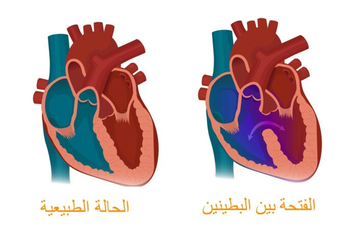 رسم تشريحي للقلب في الحالة الطبيعية وفي الحالة التي توجد فيها فتحة بين البطينين