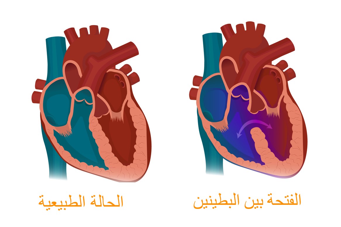 رسم تشريحي للقلب في الحالة الطبيعية وفي الحالة التي توجد فيها فتحة بين البطينين