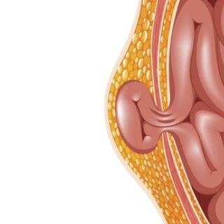 رسم توضيحي لفتق في جدار البطن حيث يخرج جزء من الأمعاء الدقيقة من جدار البطن ويستقر تحت طبقة الجلد مكوناً كتلة ضخمة
