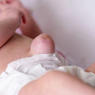 طفل رضيع ينام على بطنه وتظهر كتلة لحمية كبيرة في منطقة سرة البطن