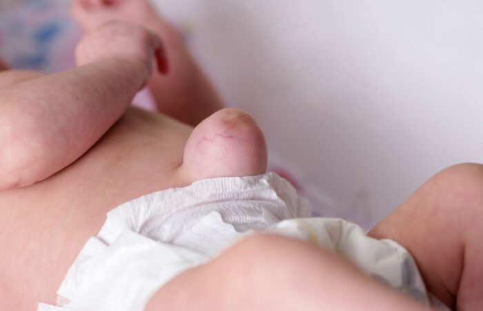 طفل رضيع ينام على بطنه وتظهر كتلة لحمية كبيرة في منطقة سرة البطن