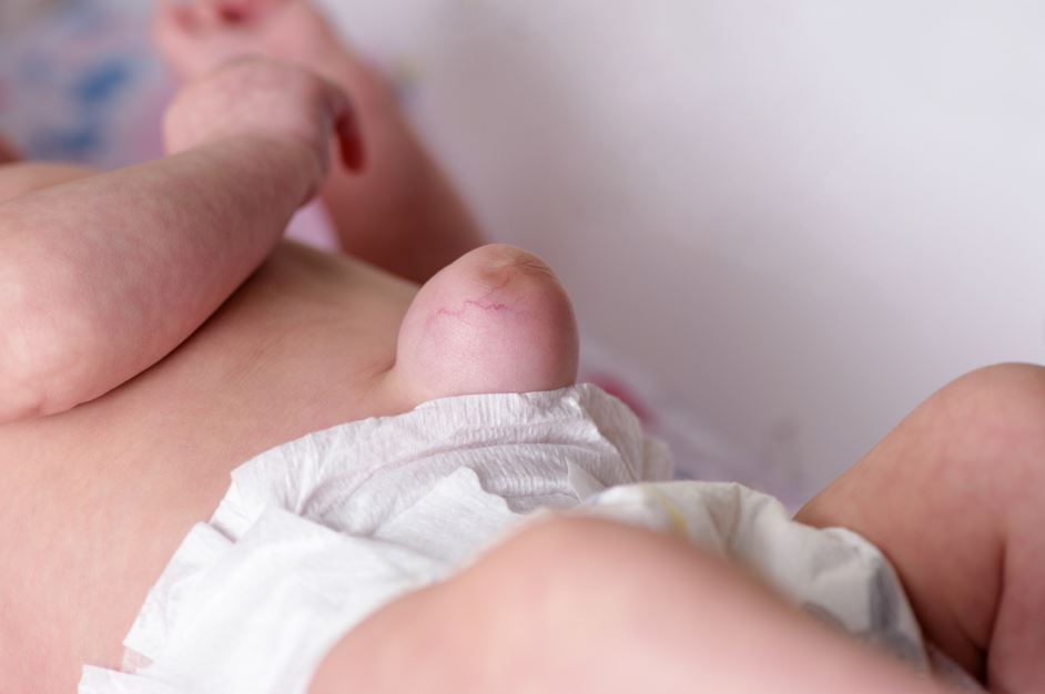 طفل رضيع ينام على بطنه وتظهر كتلة لحمية كبيرة في منطقة سرة البطن