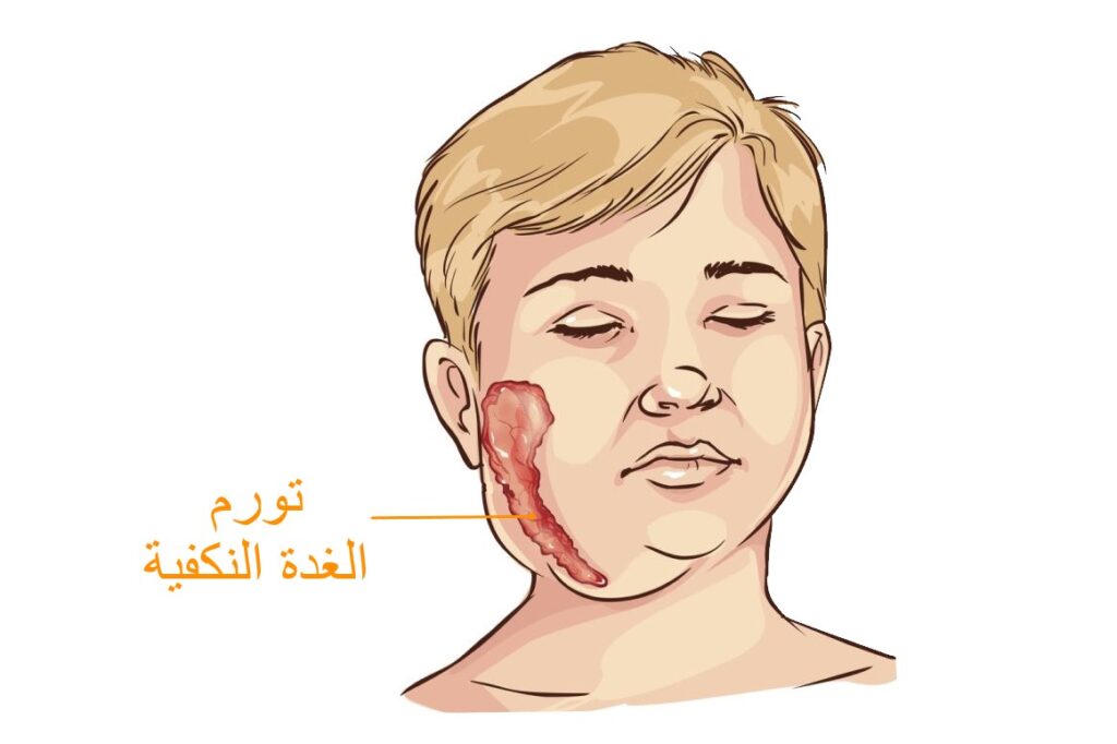 رسمة توضيحية لطفل مصاب بالنكاف ويظهر تورّم في خده الأيمن