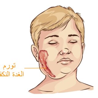 رسمة توضيحية لطفل مصاب بالنكاف ويظهر تورّم في خده الأيمن