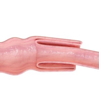 رسم توضيحي للأمعاء الدقيقة وهي متداخلة مع بعضها البعض بشكل يؤدي لانسدادها