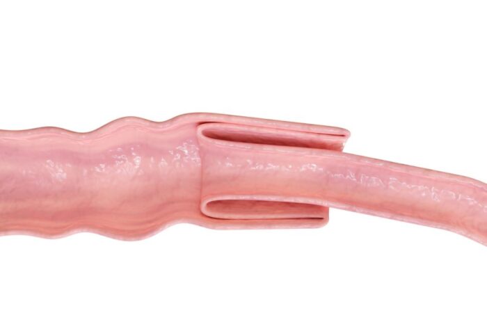 رسم توضيحي للأمعاء الدقيقة وهي متداخلة مع بعضها البعض بشكل يؤدي لانسدادها