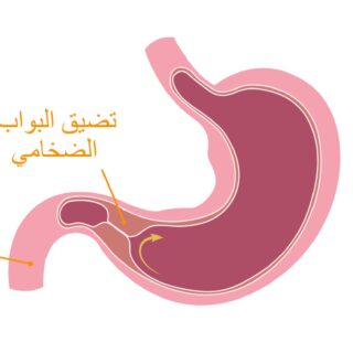 رسم توضيحي للمعدة عند الإنسان ويظهر تضخم في العنق السفلي للمعدة عند نقطة التقائها بالأمعاء الدقيقة