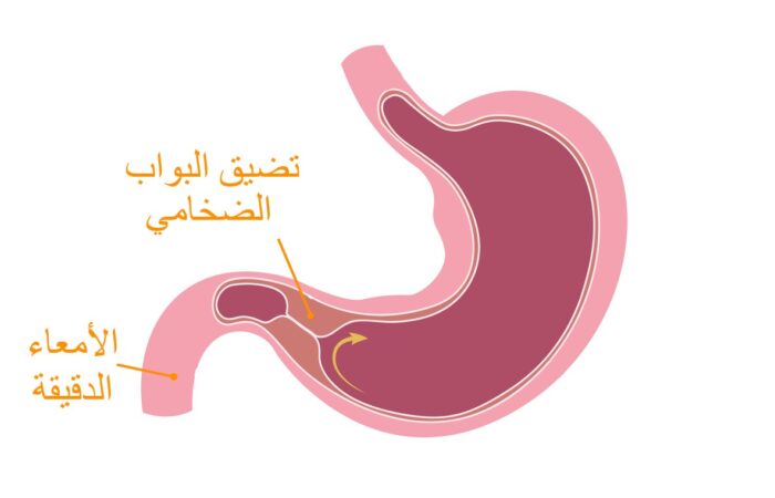 رسم توضيحي للمعدة عند الإنسان ويظهر تضخم في العنق السفلي للمعدة عند نقطة التقائها بالأمعاء الدقيقة
