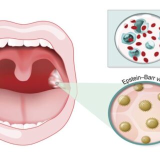 رسم توضيحي للتورمات الحاصلة في الفم نتيجة داء وحيدات النوى وتظهر أيضا الفيروسات التي تهاجم المنطقة الفموية باللون البني