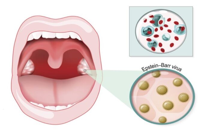 رسم توضيحي للتورمات الحاصلة في الفم نتيجة داء وحيدات النوى وتظهر أيضا الفيروسات التي تهاجم المنطقة الفموية باللون البني