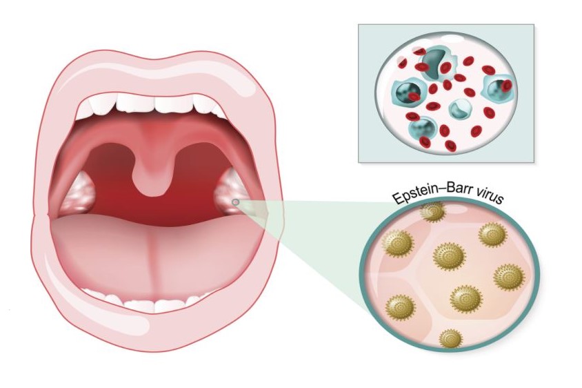 رسم توضيحي للتورمات الحاصلة في الفم نتيجة داء وحيدات النوى وتظهر أيضا الفيروسات التي تهاجم المنطقة الفموية