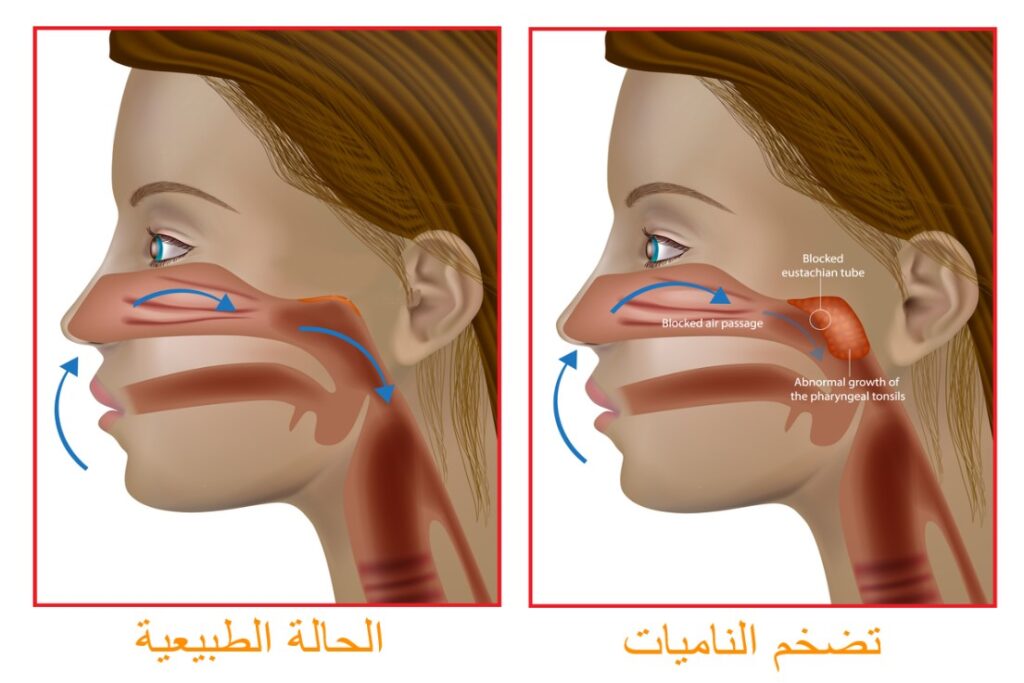 رسم توضيحي للحالة الطبيعية للمجرى التنفسي والحالة التي تكون فيها الناميات متضخمة وتعيق مرور الهواء
