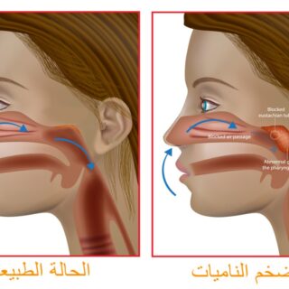 رسم توضيحي للحالة الطبيعية للمجرى التنفسي والحالة التي تكون فيها الناميات متضخمة وتعيق مرور الهواء