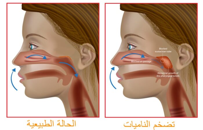 رسم توضيحي للحالة الطبيعية للمجرى التنفسي والحالة التي تكون فيها الناميات متضخمة وتعيق مرور الهواء