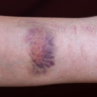 كدمات باللون الأزرق الداكن على يد إنسان نتيجة اصابته ب فرفرية نقص الصفيحات المناعية