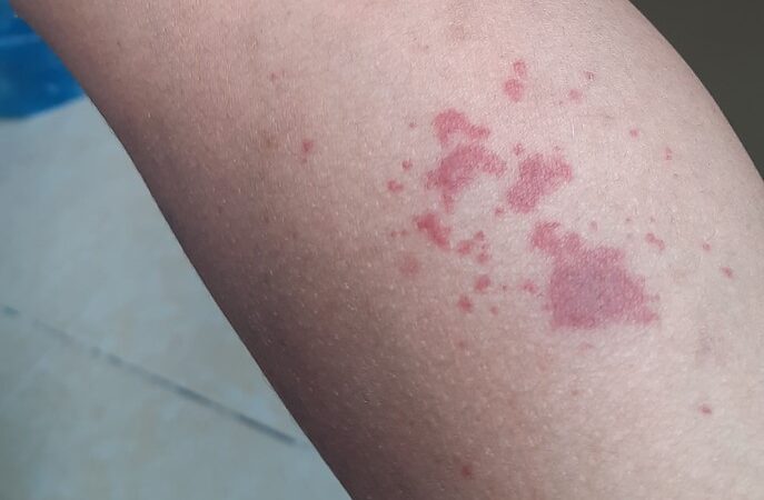 بقع جلدية حمراء اللون