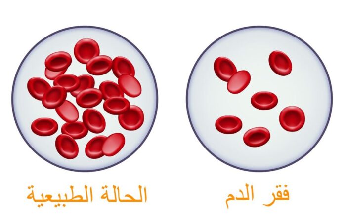 رسمة توضيحية لفقر الدم من خلال مجموعتين من كريات الدم الحمراء في الأولى يكون عدد الكريات الحمراء كثيراً وهي الحالة الطبيعية وفي الثانية يكون قليل وهي حالة فقر الدم