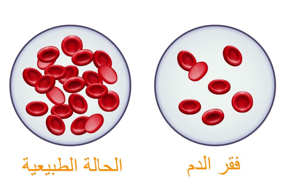 رسمة توضيحية لفقر الدم من خلال مجموعتين من كريات الدم الحمراء في الأولى يكون عدد الكريات الحمراء كثيراً وهي الحالة الطبيعية وفي الثانية يكون قليل وهي حالة فقر الدم